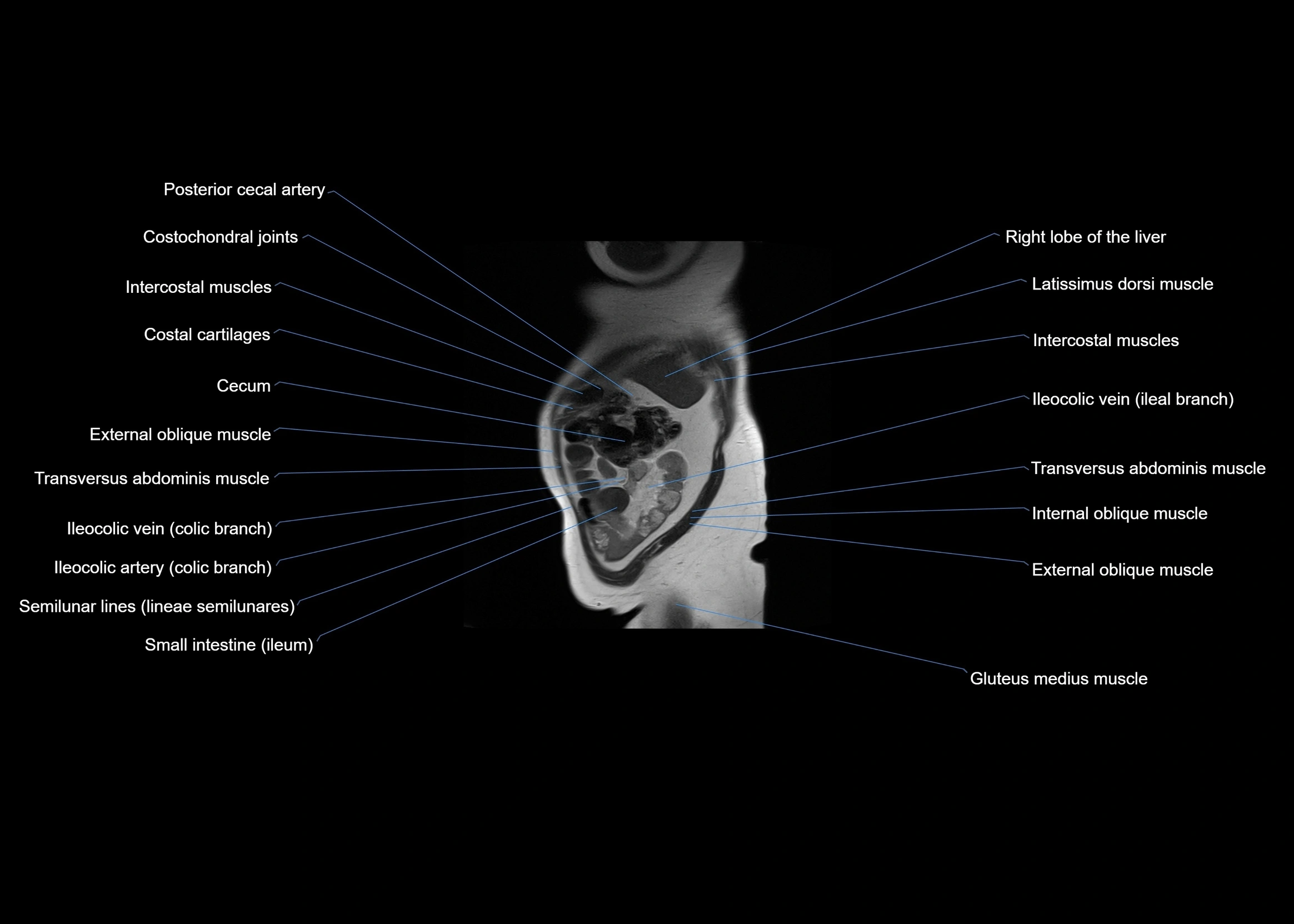 MRI abdomen sagittal cross sectional anatomy  radiology  image-img-00001-00009.webp